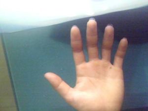 割掌療法 割掌療法