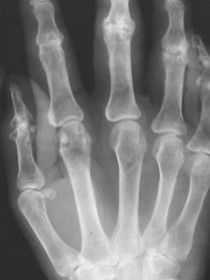 風濕寒性關節痛