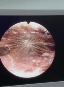 耳道內“長”出的蒲公英