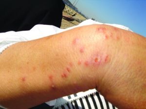 性病性淋巴肉芽腫