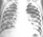 老年人陽性桿菌肺炎 老年人陽性桿菌肺炎