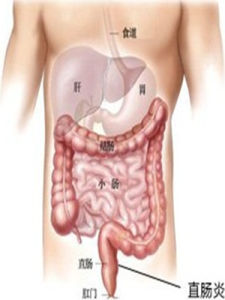潰瘍性直腸炎 潰瘍性直腸炎