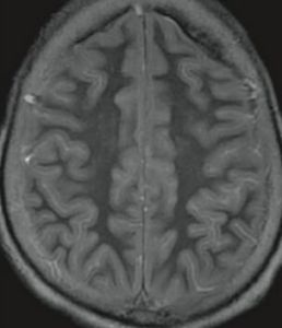 缺血性腦病 缺血性腦病