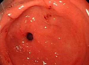 胃黏膜充血水腫 胃黏膜充血水腫