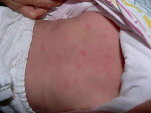 初生嬰兒的紅斑