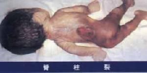 脊柱裂和有關畸形 脊柱裂和有關畸形