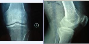 膝關節退行性變