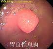 家族性結腸息肉病 家族性結腸息肉病