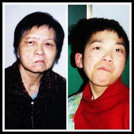 面癱症狀 面癱症狀