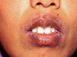 唇圓或橢圓形紅斑 唇圓或橢圓形紅斑