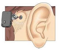 （圖）耳蝸效應