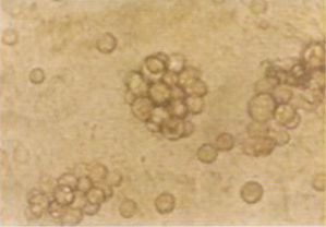 骨髓增生異常綜合徵