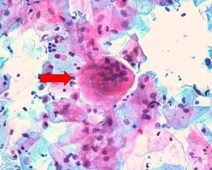 多核巨細胞 多核巨細胞