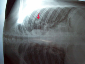 肺結節影 肺結節影