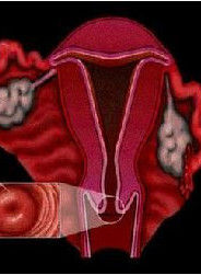 子宮頸