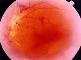 眼發脹發乾 眼發脹發乾