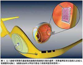 少年黃斑變性 少年黃斑變性