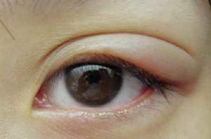 耳前淋巴結腫大 耳前淋巴結腫大