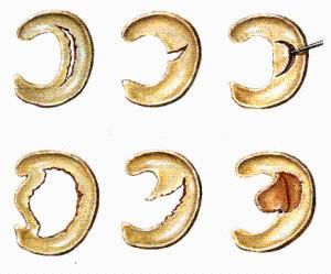 半月板損傷 半月板損傷