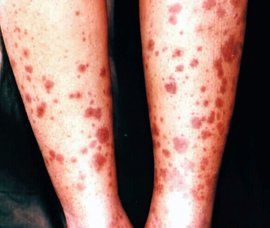 兒童過敏性紫癜