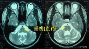 遺傳性共濟失調
