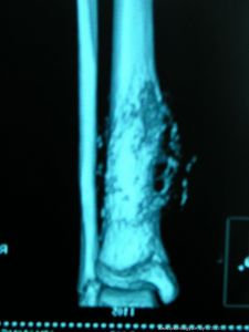 軟組織腫瘤影像