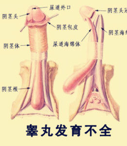 先天性睪丸發育不全 先天性睪丸發育不全