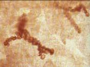 蟲卵肉芽腫 蟲卵肉芽腫