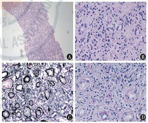 腎小管間質纖維化