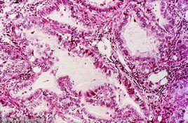 腺性肺癌 腺性肺癌