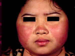 系統性紅斑狼瘡所致脊髓病