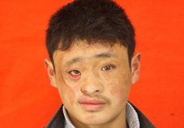 顏面部燒傷 顏面部燒傷