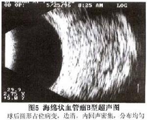 眶內海綿狀血管瘤