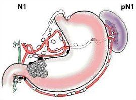 食管反流性胃炎 食管反流性胃炎