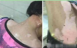 8·24溫州火鍋店開水澆頭案 8·24溫州火鍋店開水澆頭案