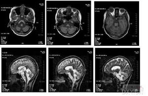 遺傳性共濟失調
