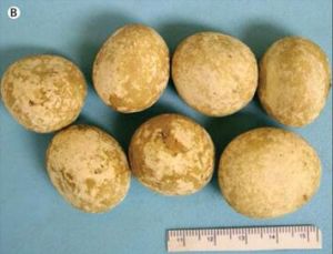 尿酸結石 尿酸結石