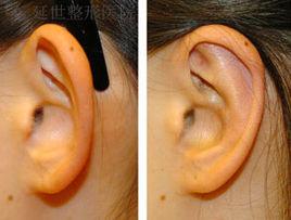 招風耳整形術 招風耳整形術
