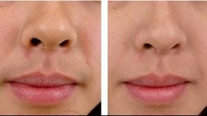 唇部脫毛 唇部脫毛