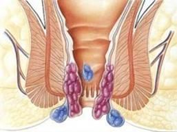 痔塊脫垂 痔塊脫垂