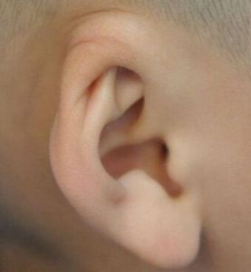 小耳畸形