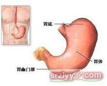 胃竇癌 胃竇癌
