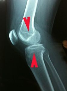 骨骺線閉合 骨骺線閉合