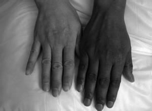 腎上腺皮質功能減退症 腎上腺皮質功能減退症