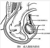 斜疝 斜疝