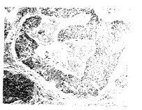 涎腺導管癌 涎腺導管癌