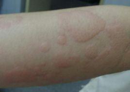 兒童過敏性蕁麻疹 兒童過敏性蕁麻疹