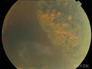 色素性靜脈旁視網膜脈絡膜萎縮