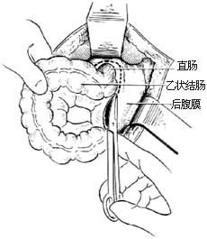 新生兒肛門和直腸畸形