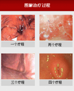 慢性萎縮性胃炎 